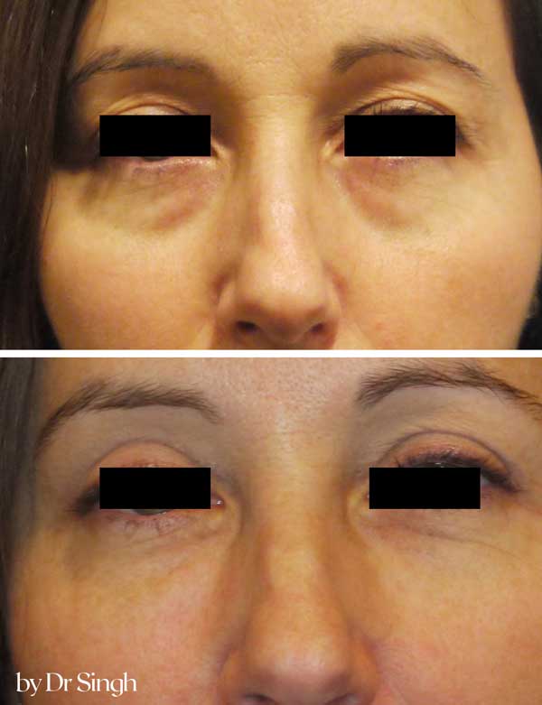 before after blepharoplasty nyc